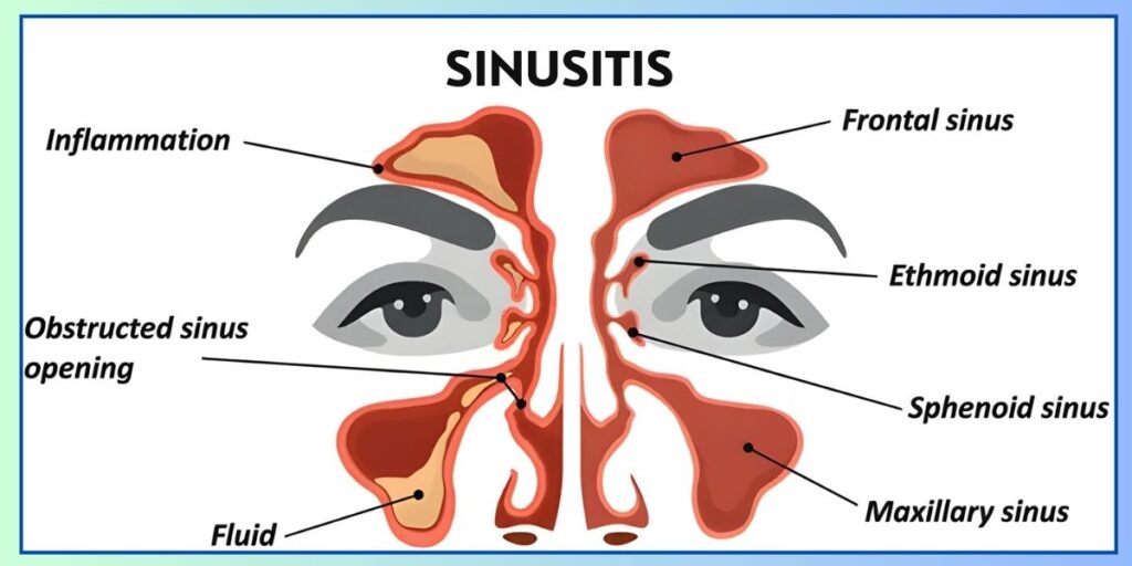 Best treatment for chronic sinusitis