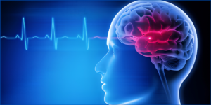 Brain Stroke Treatment